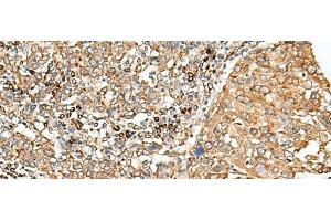 Immunohistochemistry of paraffin-embedded Human cervical cancer tissue using STT3A Polyclonal Antibody at dilution of 1:70(x200) (STT3A anticorps)