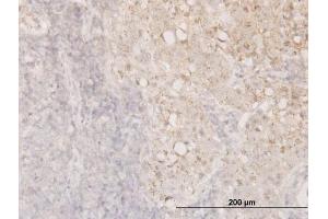 Immunoperoxidase of monoclonal antibody to CFL1 on formalin-fixed paraffin-embedded human breast cancer.