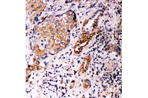 Anti-Annexin A10 antibody, IHC(P) IHC(P): Human Lung Cancer Tissue (Annexin a10 anticorps  (C-Term))