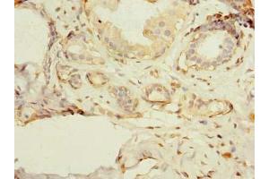 Immunohistochemistry of paraffin-embedded human breast cancer using ABIN7163030 at dilution of 1:100 (PSD4 anticorps  (AA 1-300))
