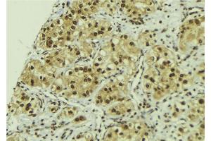 ABIN6267198 at 1/100 staining Human breast cancer tissue by IHC-P. (TLK1 anticorps  (pSer743))