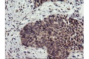 Immunohistochemical staining of paraffin-embedded Carcinoma of Human lung tissue using anti-LRRC25 mouse monoclonal antibody. (LRRC25 anticorps)