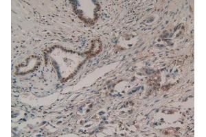 IHC-P analysis of Human Pancreas Cancer Tissue, with DAB staining. (EZH2 anticorps  (AA 51-285))