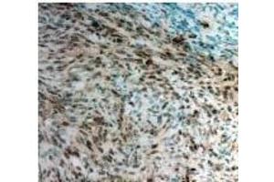 Twist1 Antibody staining Twist in Mouse pancreatic cancer tissue sections by Immunohistochemistry (TWIST1 anticorps)