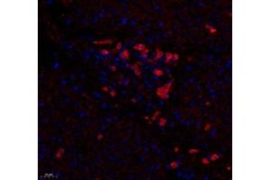 Immunofluorescence of paraffin embedded human colon cancer using DCR3 (ABIN7076071) at dilution of 1: 700 (400x lens)