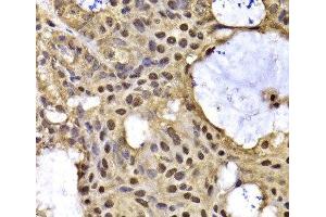 Immunohistochemistry of paraffin-embedded Human oophoroma using ARID3A Polyclonal Antibody at dilution of 1:100 (40x lens).