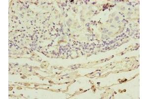 Immunohistochemistry of paraffin-embedded human lung cancer using ABIN7164324 at dilution of 1:100
