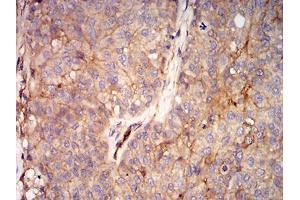 Immunohistochemical analysis of paraffin-embedded bladder cancer tissues using RALB mouse mAb with DAB staining. (RALB anticorps  (AA 89-206))