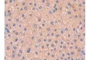 Detection of PAH in Human Liver cancer Tissue using Polyclonal Antibody to Phenylalanine Hydroxylase (PAH)