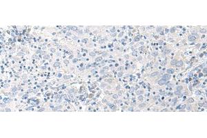 Immunohistochemistry of paraffin-embedded Human cervical cancer tissue using STAU2 Polyclonal Antibody at dilution of 1:45(x200)