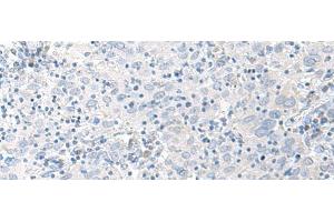 Immunohistochemistry of paraffin-embedded Human cervical cancer tissue using STAU2 Polyclonal Antibody at dilution of 1:45(x200) (Double-stranded RNA-binding protein Staufen homolog 2 (STAU2) anticorps)