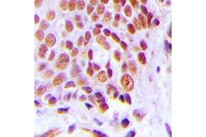 Immunohistochemical analysis of C/EBP gamma staining in human breast cancer formalin fixed paraffin embedded tissue section.