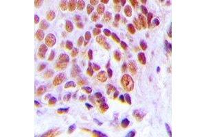 Immunohistochemical analysis of C/EBP gamma staining in human breast cancer formalin fixed paraffin embedded tissue section. (CEBPG anticorps)