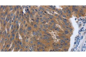 Immunohistochemistry of paraffin-embedded Human ovarian cancer tissue using PDGFA Polyclonal Antibody at dilution 1:70 (PDGFA anticorps)