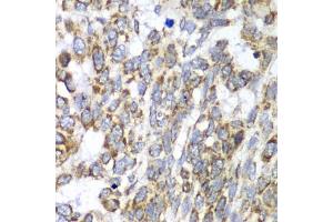 Immunohistochemistry of paraffin-embedded human esophageal cancer using DLST antibody (ABIN6130277, ABIN6139665, ABIN6139667 and ABIN6217240) at dilution of 1:100 (40x lens).