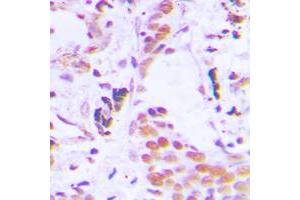 Immunohistochemical analysis of TCEB3C staining in human breast cancer formalin fixed paraffin embedded tissue section.