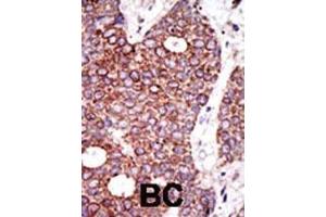 Formalin-fixed and paraffin-embedded human cancer tissue reacted with the primary antibody, which was peroxidase-conjugated to the secondary antibody, followed by DAB staining.