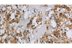 Immunohistochemistry of paraffin-embedded Human thyroid cancer using SYN1 Polyclonal Antibody at dilution of 1:40 (SYN1 anticorps)