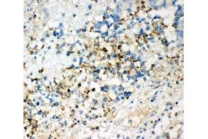 IHC-P: CD63 antibody testing of human intestinal cancer tissue (CD63 anticorps  (AA 97-238))
