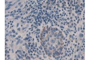 Detection of CDH16 in Human Skin cancer Tissue using Polyclonal Antibody to Cadherin 16 (CDH16)