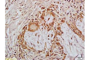 Formalin-fixed and paraffin embedded human cervical carcinoma labeled with Anti-MACC1 Polyclonal Antibody, Unconjugated (ABIN706526) at 1:200 followed by conjugation to the secondary antibody and DAB staining (MACC1 anticorps  (AA 761-852))