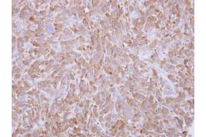 IHC-P Image Immunohistochemical analysis of paraffin-embedded MDA-MB-231 xenograft, using Profilin 1, antibody at 1:500 dilution.