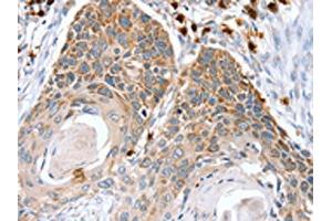 The image on the left is immunohistochemistry of paraffin-embedded Human esophagus cancer tissue using ABIN7130898(RNF185 Antibody) at dilution 1/20, on the right is treated with fusion protein. (RNF185 anticorps)