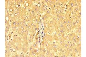 Immunohistochemistry of paraffin-embedded human liver cancer using ABIN7149746 at dilution of 1:100 (DSE anticorps  (AA 23-270))