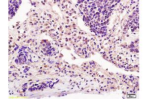 Formalin-fixed and paraffin embedded human lung carcinoma labeled with Anti-ICOS/CD278 Polyclonal Antibody, Unconjugated (ABIN742380) at 1:200 followed by conjugation to the secondary antibody and DAB staining (ICOS anticorps  (AA 51-150))