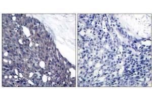 Immunohistochemical analysis of paraffin-embedded human breast carcinoma tissue using IκB-α (Ab-42) antibody (E021176). (NFKBIA anticorps)