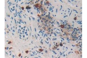 Detection of PRSS2 in Human Lung cancer Tissue using Polyclonal Antibody to Protease, Serine 2 (PRSS2)