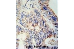 B3GNT6 Antibody (Center) (ABIN653842 and ABIN2843106) immunohistochemistry analysis in formalin fixed and paraffin embedded human colon carcinoma followed by peroxidase conjugation of the secondary antibody and DAB staining. (B3GNT6 anticorps  (AA 146-173))