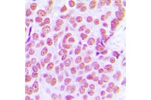 Immunohistochemical analysis of c-Jun staining in human breast cancer formalin fixed paraffin embedded tissue section. (C-JUN anticorps  (Center))