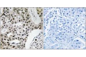 Immunohistochemistry analysis of paraffin-embedded human breast carcinoma tissue, using ZMYM4 Antibody. (ZMYM4 anticorps  (AA 801-850))