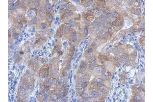 IHC-P Image Immunohistochemical analysis of paraffin-embedded human colon carcinoma, using IKK beta, antibody at 1:500 dilution.