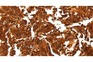 Immunohistochemistry of paraffin-embedded Human gastic cancer using ALDOA Polyclonal Antibody at dilution of 1:30 (ALDOA anticorps)
