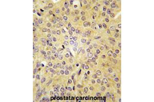Formalin-fixed and paraffin-embedded human prostate carcinomareacted with LARS polyclonal antibody , which was peroxidase-conjugated to the secondary antibody, followed by AEC staining. (LARS anticorps  (C-Term))