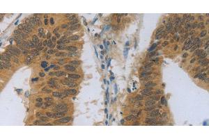 Immunohistochemistry of paraffin-embedded Human colon cancer using TNFRSF11B Polyclonal Antibody at dilution of 1:30 (Osteoprotegerin anticorps)