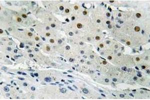 Immunohistochemistry (IHC) analyzes of Dlx-4 antibody in paraffin-embedded human liver carcinoma tissue. (DLX4 anticorps)