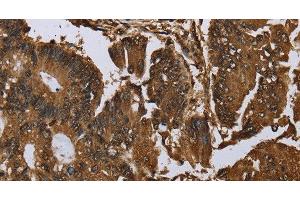 Immunohistochemistry of paraffin-embedded Human colon cancer tissue using MYBBP1A Polyclonal Antibody at dilution 1:40 (MYBBP1A anticorps)
