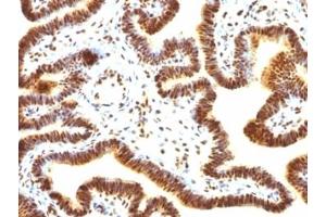 Formalin-fixed, paraffin-embedded human ovarian carcinoma stained with SUMO-1 antibody (SUMO1/1188) (SUMO1 anticorps)