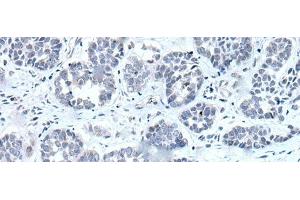 Immunohistochemistry of paraffin-embedded Human esophagus cancer tissue using RARG Polyclonal Antibody at dilution of 1:55(x200)