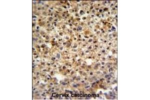 KI Antibody (C-term) (ABIN651358 and ABIN2840200) IHC analysis in formalin fixed and paraffin embedded human cervix carcinoma followed by peroxidase conjugation of the secondary antibody and DAB staining. (CCDC180 anticorps  (C-Term))