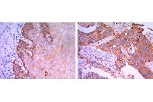 Immunohistochemical analysis of paraffin-embedded esophagus tissues (left) and human lung cancer (right) using Rab25 mouse mAb with DAB staining. (RAB25 anticorps)