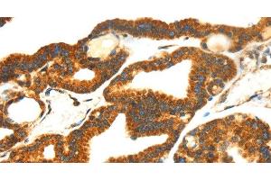 Immunohistochemistry of paraffin-embedded Human thyroid cancer tissue using SMYD4 Polyclonal Antibody at dilution 1:40 (SMYD4 anticorps)