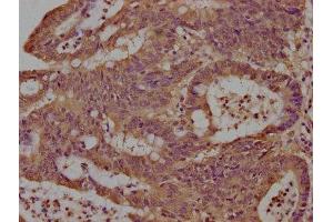 IHC image of ABIN7165733 diluted at 1:100 and staining in paraffin-embedded human colon cancer performed on a Leica BondTM system.