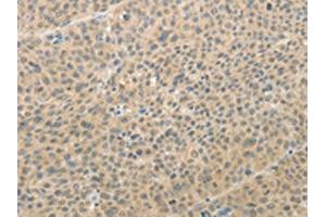The image on the left is immunohistochemistry of paraffin-embedded Human liver cancer tissue using ABIN7189710(AFF2 Antibody) at dilution 1/25, on the right is treated with synthetic peptide. (AFF2 anticorps)