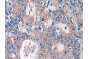 Detection of IL33 in Human Colorectal cancer Tissue using Monoclonal Antibody to Interleukin 33 (IL33)