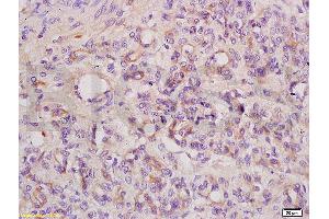 Formalin-fixed and paraffin embedded mouse tumor tissue labeled with Anti ANGPT3 ANG3 ANGPT4 ANG4 Polyclonal Antibody, unconjugated (ABIN737466) at 1:200 followed by incubation with conjugated secondary antibody and DAB staining. (Angiopoietin 4 anticorps  (AA 410-503))