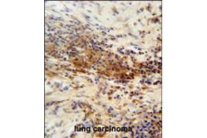 DNAJC11 antibody immunohistochemistry analysis in formalin fixed and paraffin embedded human lung carcinoma followed by peroxidase conjugation of the secondary antibody and DAB staining.